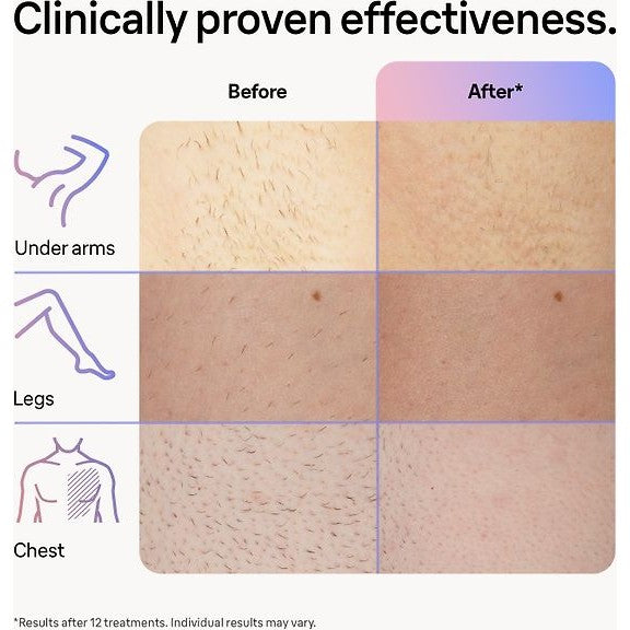 Braun Smart IPL Skin iExpert PL7253 IPL Device